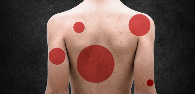 25 ألف إصابة… ماذا نعرف عن الانتشار الوبائي لـ
